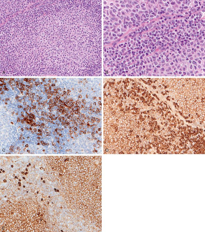 Figure 18-2, Follicular lymphoma (FL) with plasmacytic differentiation. A, FL with a follicular growth pattern, comprising a large proportion of centroblasts, and a subset of cells with cytologic evidence of plasma cell differentiation, within the follicles and at their periphery. B, The periphery of the follicles and the interfollicular zones comprise numerous cells with plasmacytic differentiation in the form of cytoplasmic inclusions and/or eosinophilic nuclear pseudoinclusions (Dutcher bodies) of immunoglobulin. C, The plasma cell component is highlighted by CD138 immunostaining. D and E, There is monotypic expression of κ light chains by the plasma cells (D), whereas only rare plasma cells appear to express λ light chains (E).