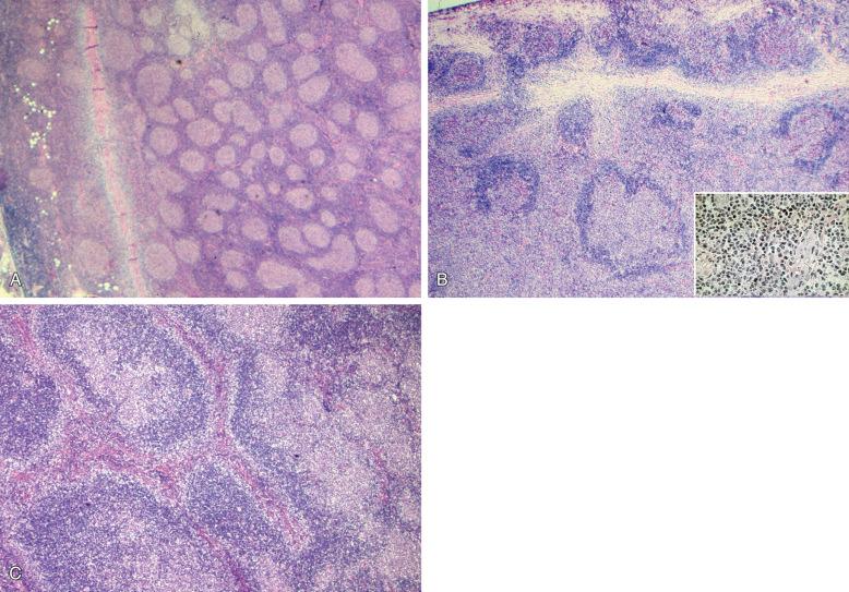 Figure 18-4, Morphologic patterns of follicular lymphoma (FL). A, In a typical case, the relatively uniform follicles are slightly larger than most reactive follicles. Note the extension of neoplastic follicles beyond the capsule (left), with concentric bands of fibrosis. B, Some cases of FL are composed of irregularly shaped follicles with focally prominent mantle zones. This example has prominent interfollicular and extracapsular involvement. Interfollicular regions (inset) contain predominantly small centrocytes, and high endothelial venules may be numerous. C, The floral variant of FL shows broken-up follicles within a mantle zone of small lymphocytes, resembling follicle lysis or progressively transformed germinal centers or nodular lymphocyte-predominant Hodgkin's lymphoma.