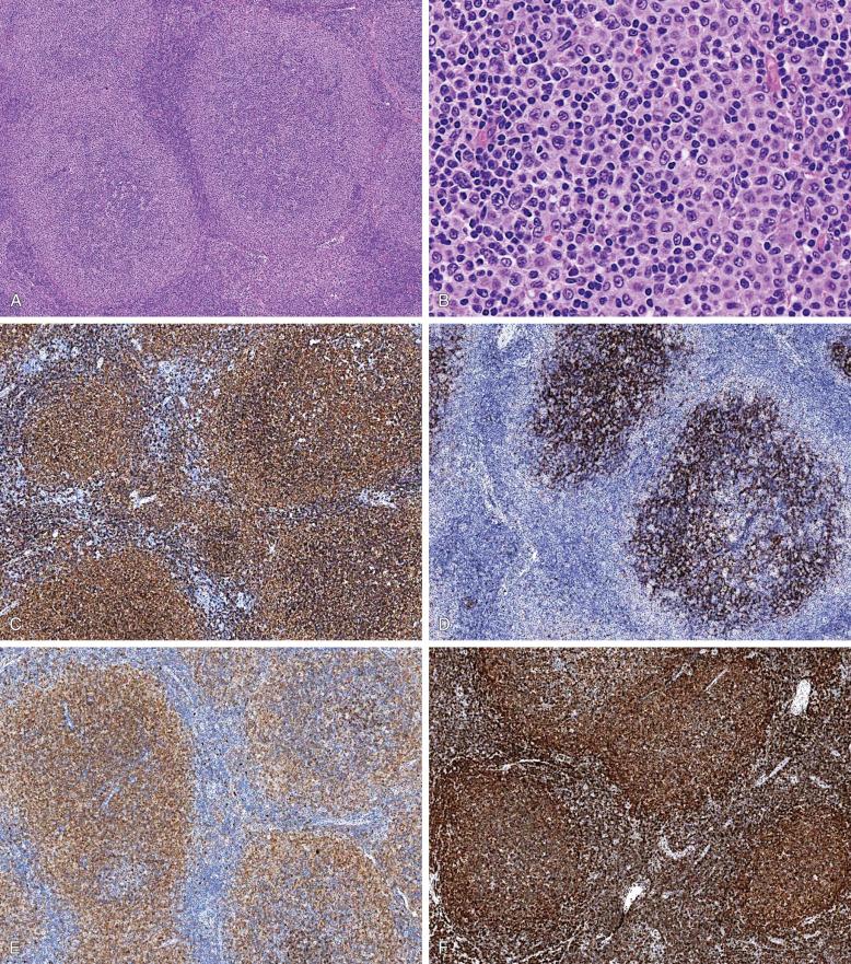 Figure 18-5, Follicular lymphoma with marginal-zone differentiation.