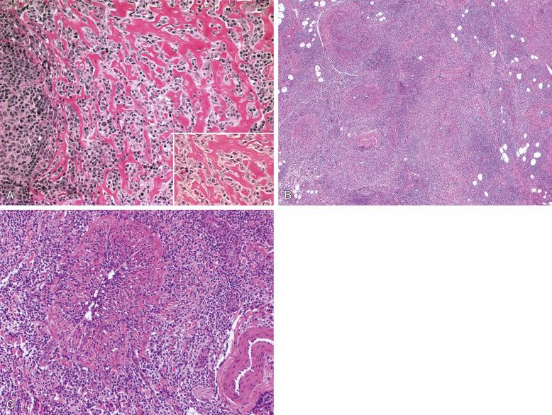 Figure 18-6, Additional morphologic patterns of follicular lymphoma (FL). A, Diffuse area in low-grade FL contains prominent sclerosis; the follicle is shown on the left. Inset shows a predominance of centrocytes with distorted, elongated nuclei. B, Prominent infiltration of hilar vessel walls in a lymph node involved by FL. C, The neoplastic lymphoid cells infiltrate the wall of a small vein, resulting in obliteration of the lumen; note an intact arteriole (right).