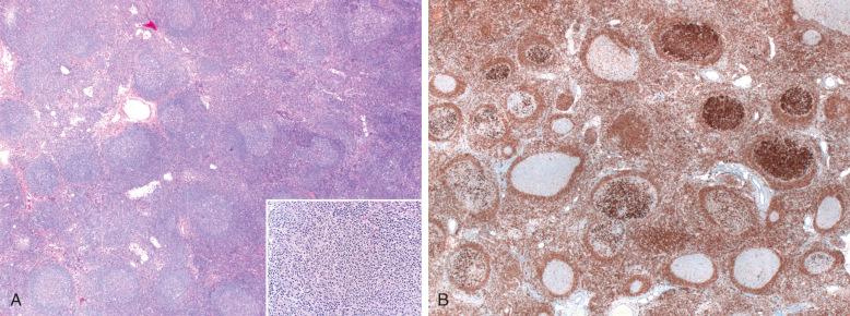 Figure 18-7, Partial nodal involvement by follicular lymphoma (FL). A, lymph node partially involved by FL contains scattered monomorphous-appearing follicles, among other typical reactive follicles with preserved mantle zones. A neoplastic follicle at higher magnification shows a monotonous cellular composition (inset). B, BCL2 stain shows strongly positive cells in some follicles.