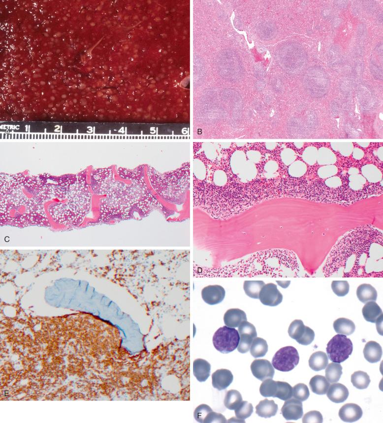 Figure 18-8, Appearance of follicular lymphoma (FL) in the spleen, bone marrow, and peripheral blood. A, In this gross photograph of a spleen involved by FL, the white pulp follicles are increased in size and number, and most are relatively round. B, In a low-power photomicrograph of FL in the spleen, white pulp follicles are enlarged and increased in number; preserved marginal zones are present around some of the neoplastic follicles. C, In this bone marrow trephine biopsy, a broad cuff of neoplastic lymphoid cells surrounds many bony trabeculae. Residual normal hematopoietic marrow is present away from the bone and is recognizable as areas with a normal distribution of fat. D, At higher magnification, there is a predominance of centrocytes. E, Immunoperoxidase stain for CD20 confirms that they are B cells. F, Peripheral blood smear in a patient with FL shows circulating centrocytes with prominent nuclear clefts (Wright's stain).