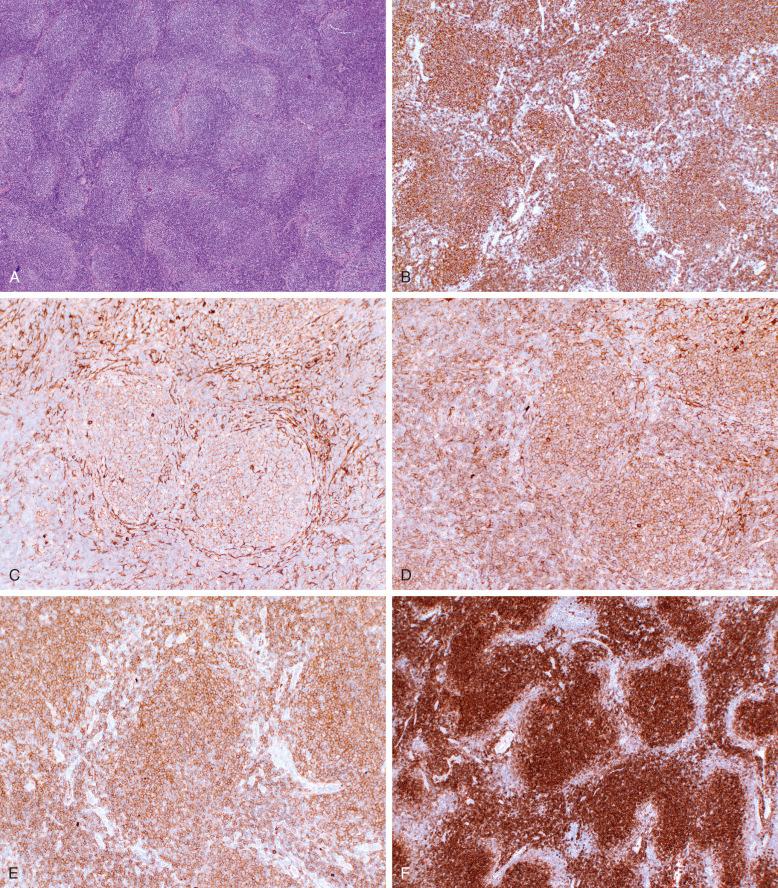 Figure 18-10, Immunohistochemistry of follicular lymphoma (FL) with immunoperoxidase stains in paraffin sections. A, A view at low magnification shows lymphoproliferation with a nodular pattern. B, FL stained for CD20 shows CD20-positive B cells present both within and between the follicles. C-E, Immunostains for immunoglobulin light and heavy chains demonstrated faint interstitial staining for kappa light chain (C), and monotypic expression of lambda light chain (D) and immunoglobulin M (IgM) (E) at the membrane of the lymphoma cells. F, FL immunostained for CD10 shows strongly positive cells largely confined to follicles; interfollicular neoplastic cells may downregulate CD10. G, FL stained for BCL6 shows brightly positive cells essentially within the follicles, whereas a few interfollicular cells show fainter BCL6 staining. H, Immunoperoxidase stain for BCL2 in FL shows strong, uniform positivity within follicles. I, Immunoperoxidase stains showing differential results with Dako and Epitomics anti-BCL2 antibodies in a case of grade 3a FL with BCL2 rearrangement documented by fluorescence in situ hybridization; the neoplastic follicles are negative for BCL2 with the Dako antibody ( a and c ), and positive for BCL2 when the Epitomics antibody is used ( b and d ). J, Follicular dendritic cells associated with neoplastic follicles are highlighted by CD21. K, Immunostaining of FL for CD5 shows that neoplastic follicles contain few T cells, whereas numerous T cells are present in the interfollicular region. L, The proliferation fraction with Ki67 is typically low. M and N, Rare cases of low-grade FL (M) have a high proliferation fraction with Ki-67 (>40%) (N).