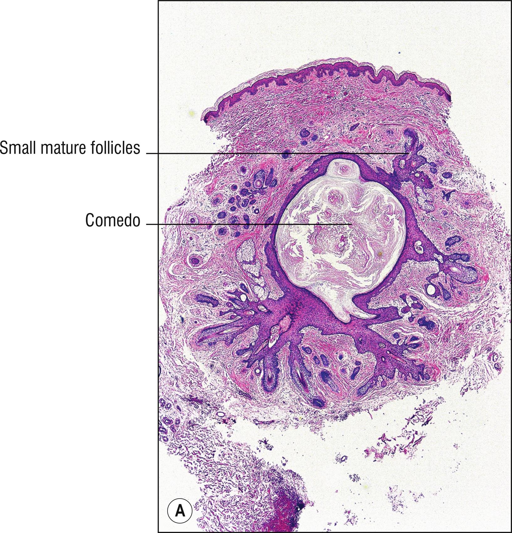 Fig. 22.1, A Trichofolliculoma (low mag.).