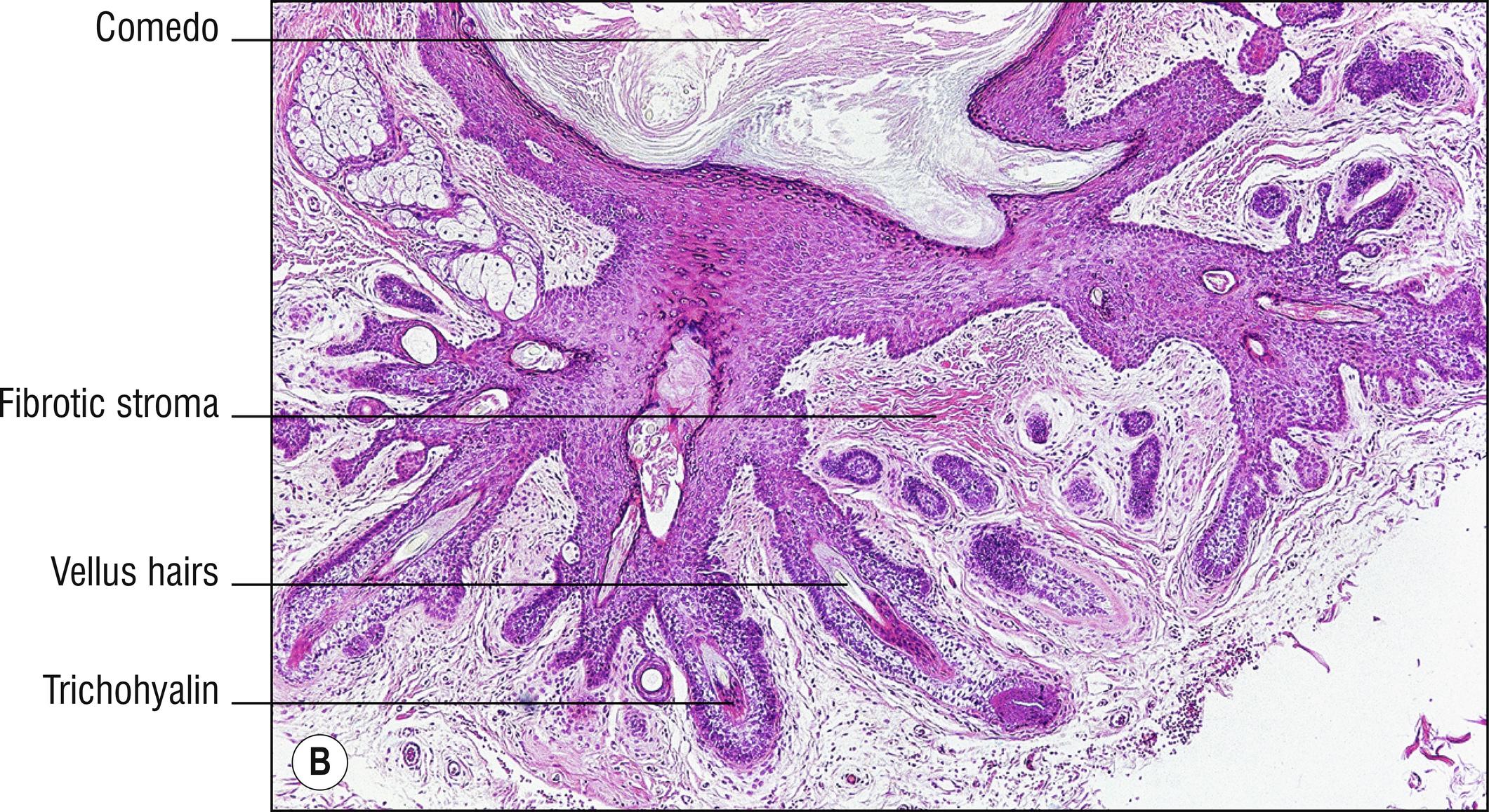 Fig. 22.1, B Trichofolliculoma (high mag.).