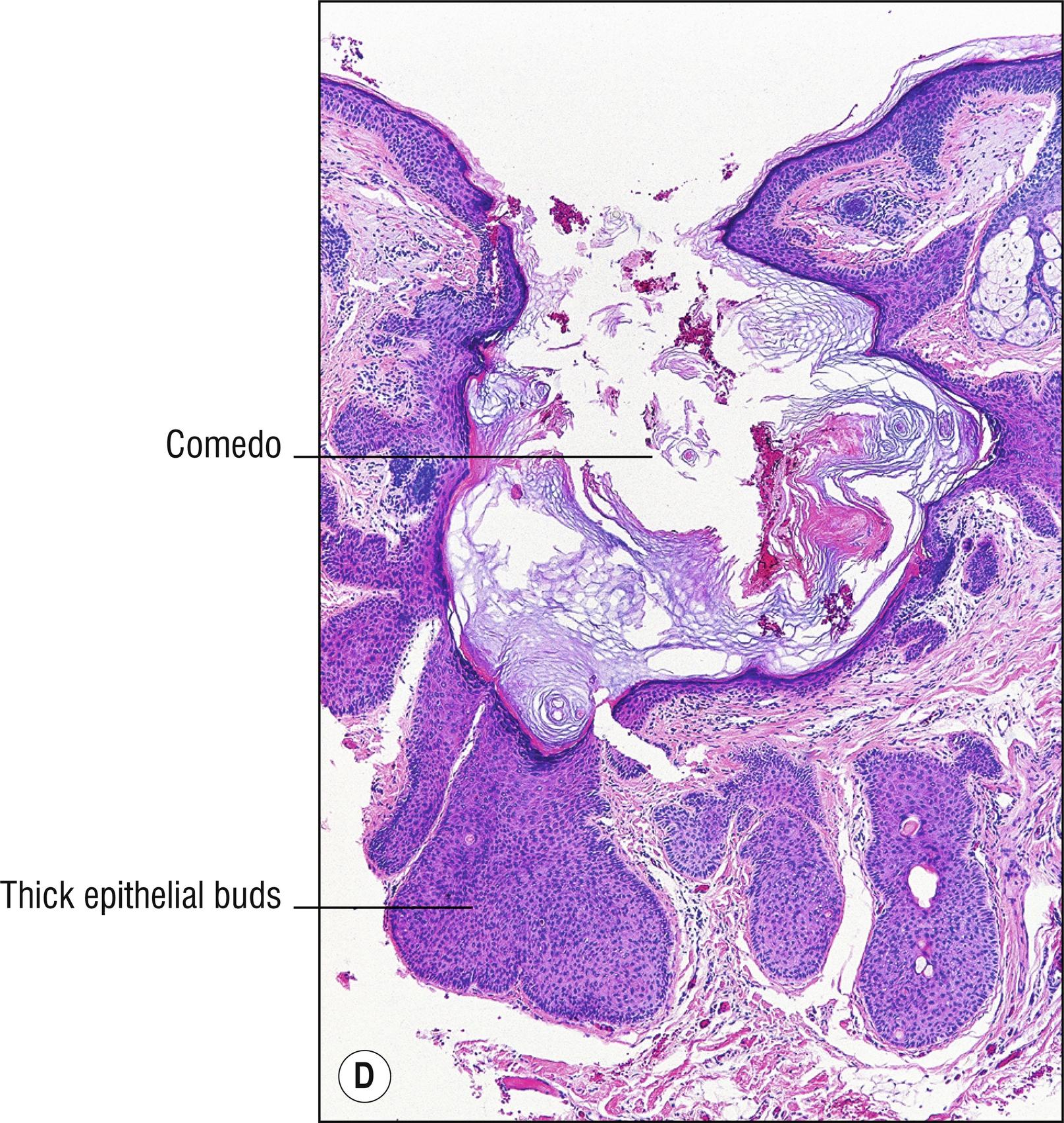 Fig 22.1, D Pilar sheath acanthoma.