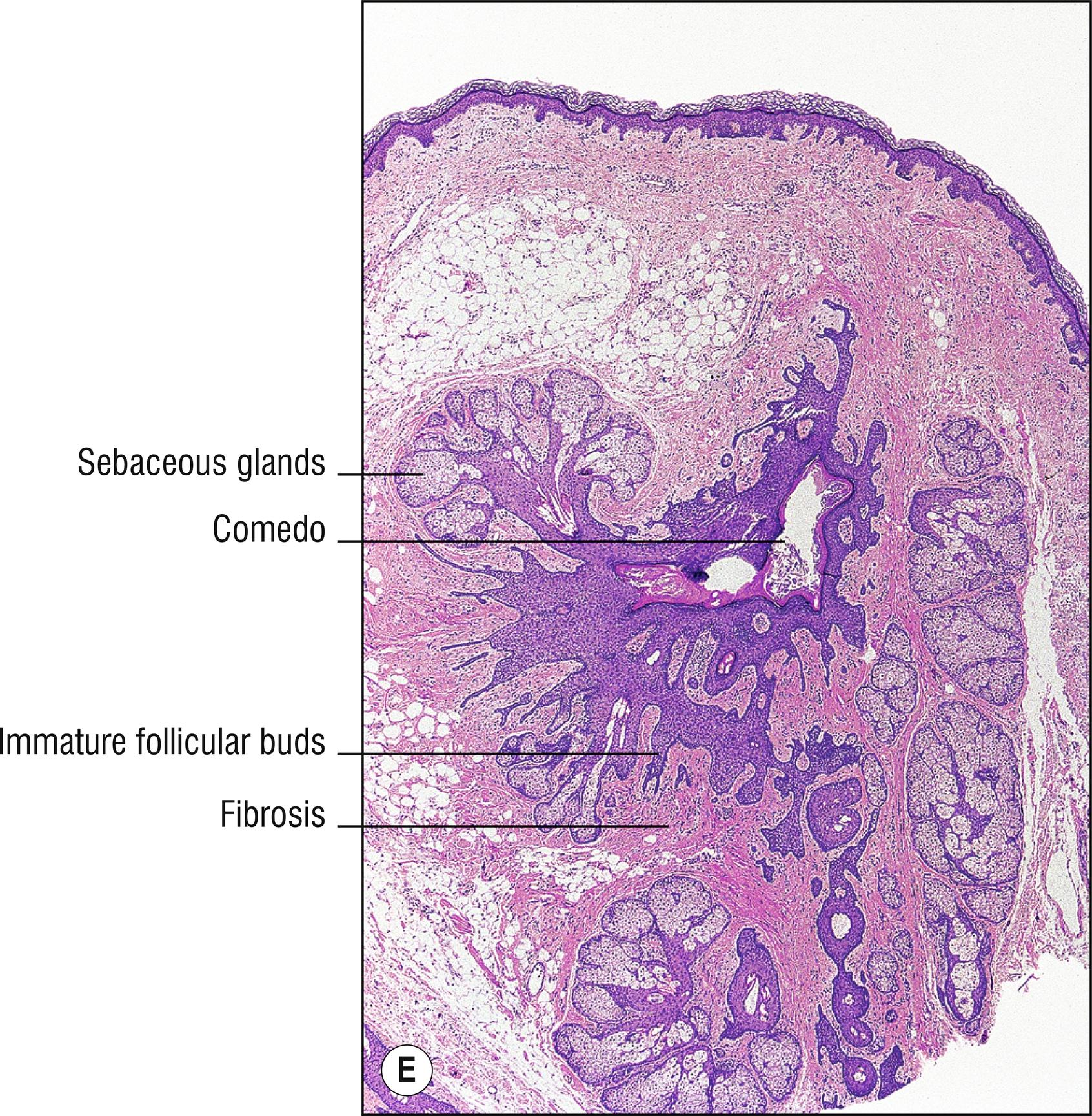 Fig. 22.1, E Folliculosebaceous cystic hamartoma.