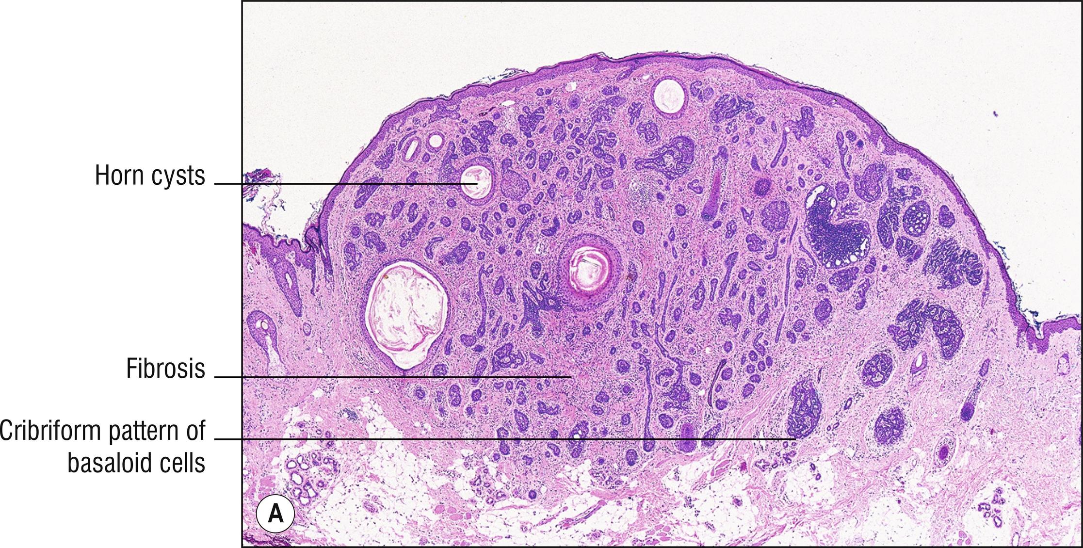 Fig. 22.2, A Trichoepithelioma (low mag.).