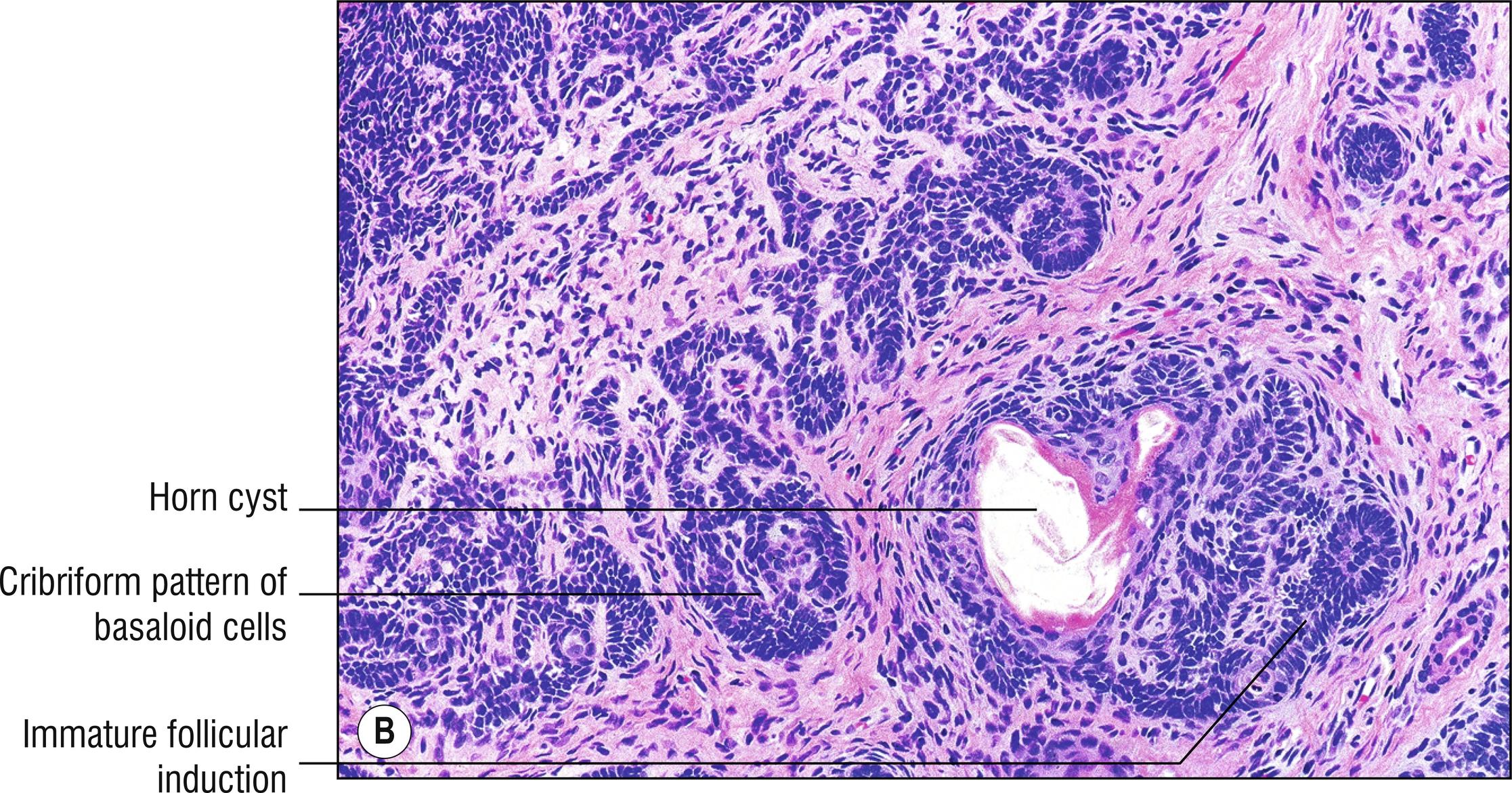 Fig. 22.2, B Trichoepithelioma (medium mag.).