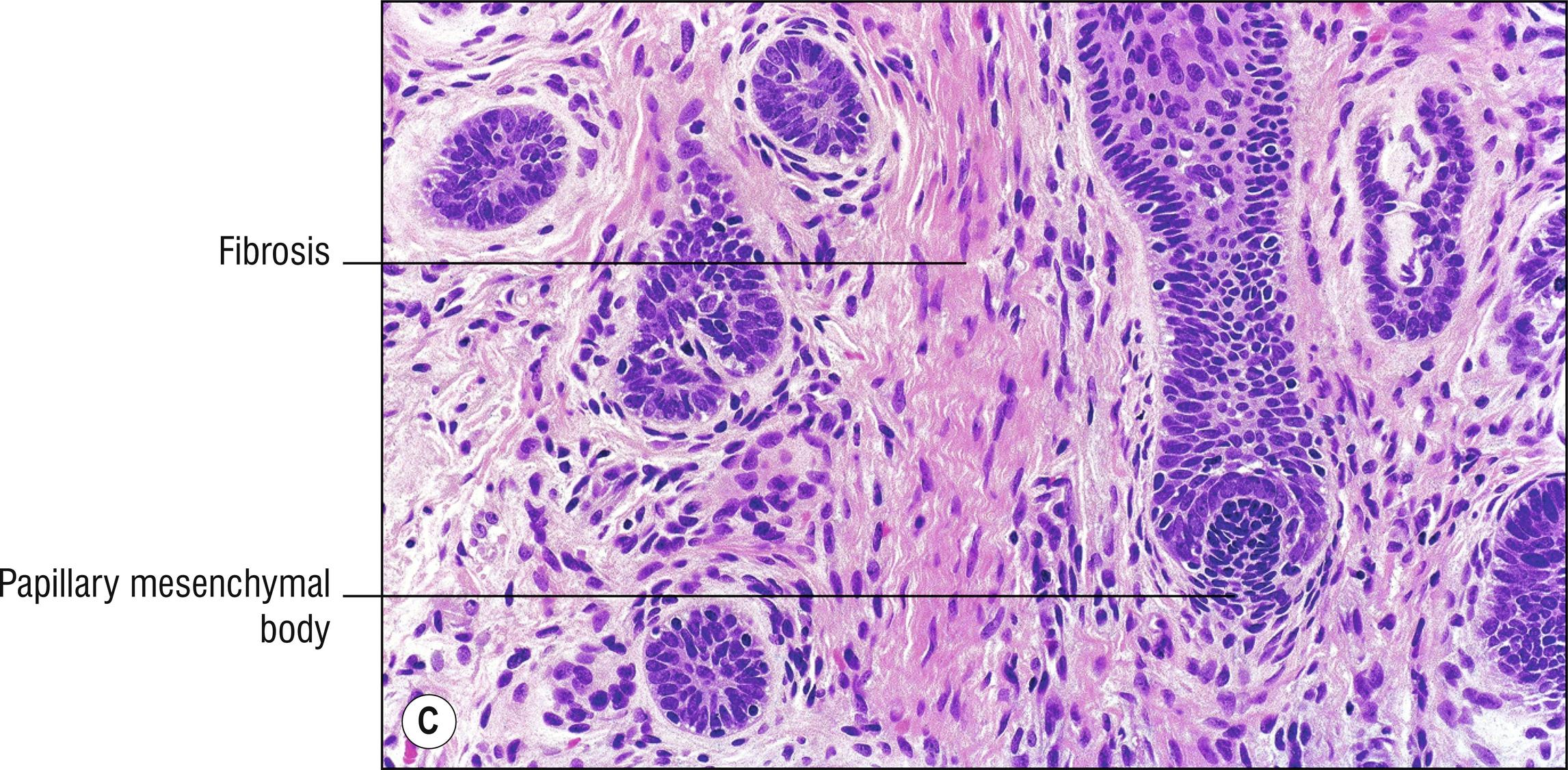 Fig. 22.2, C Trichoepithelioma (high mag.).