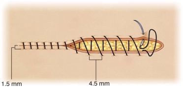 FIGURE 30.11, Schematic of the suturing technique recommended for closing the donor scalp. The spacing between loops is 4.5 mm.