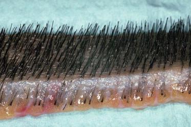 FIGURE 30.12, Close-up view of a donor strip showing the natural hair groupings at the surface, the slightly curved path of the hair through the dermis, and the random distribution of bulbs in the fat. It is this unique anatomy that makes stereomicroscopic dissection essential in preventing follicular transection.