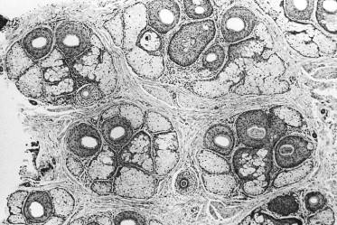 FIGURE 30.3, Histologic view of follicular units corresponding to the natural hair groups observed on the scalp surface. Transverse section taken at the level of sebaceous glands (H&E; original magnification ×40).