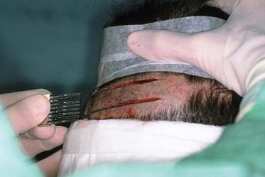 FIGURE 30.7, Donor-strip harvesting using two parallel blades on a Rassman handle pre-angled at 30° to allow both blades to lie flush against the scalp.