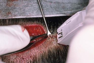 FIGURE 30.9, Stapling technique illustrating very controlled apposition of wound edges, using skin hooks for the lower edge, and forceps to evert the upper.