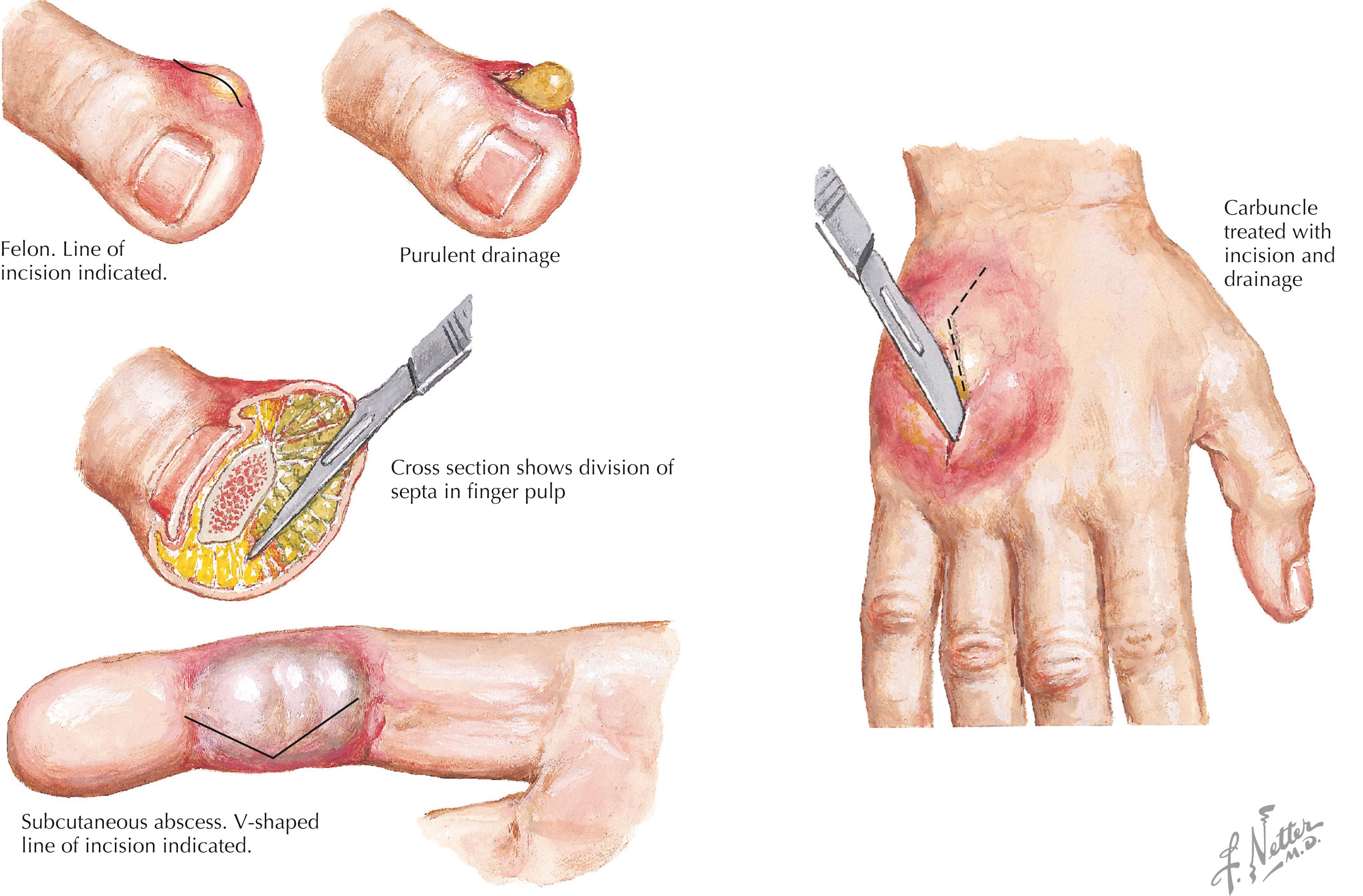 Fig. 20.1, Cellulitis and epidermal access.