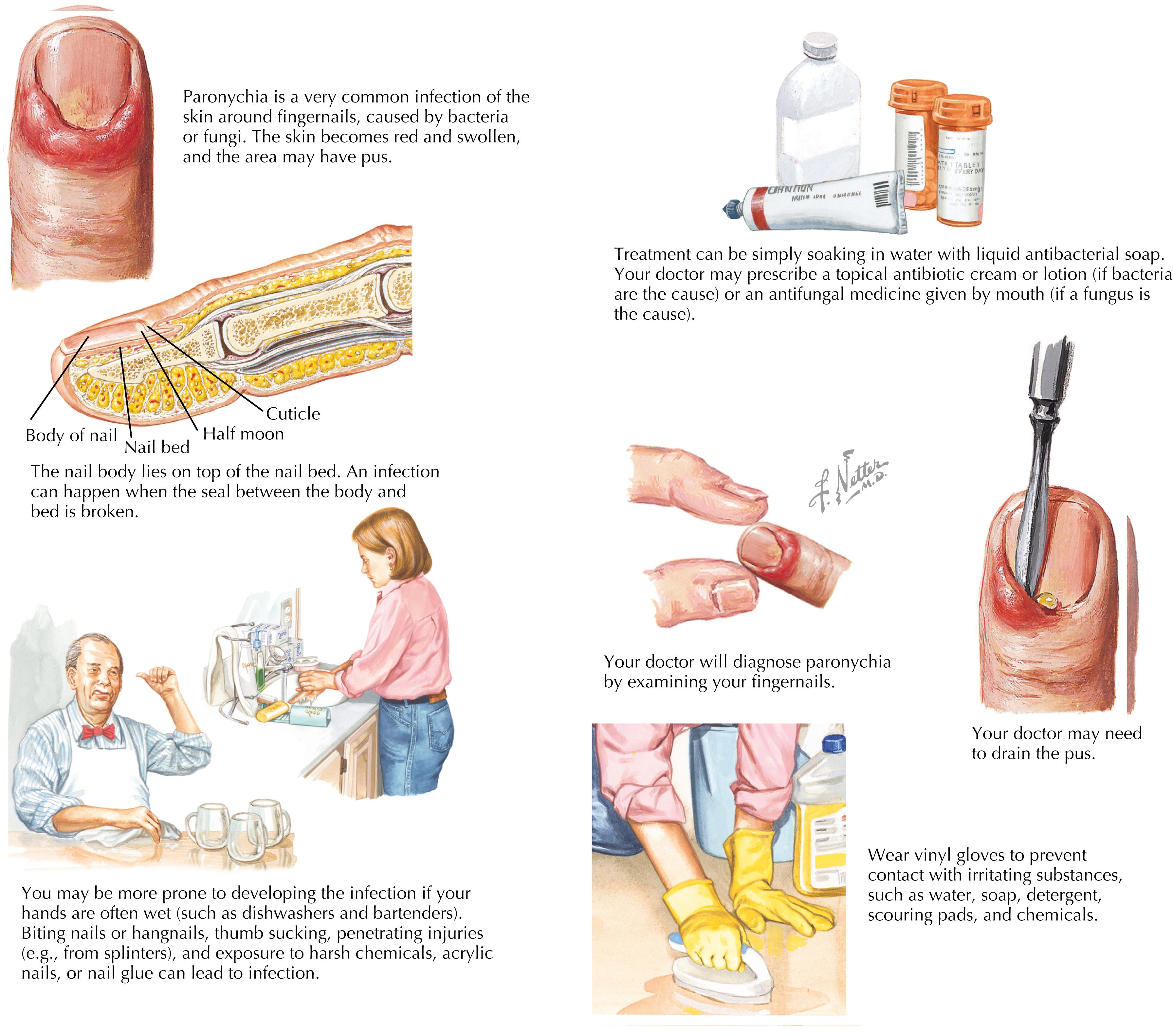 Fig. 20.2, Managing paronychia.