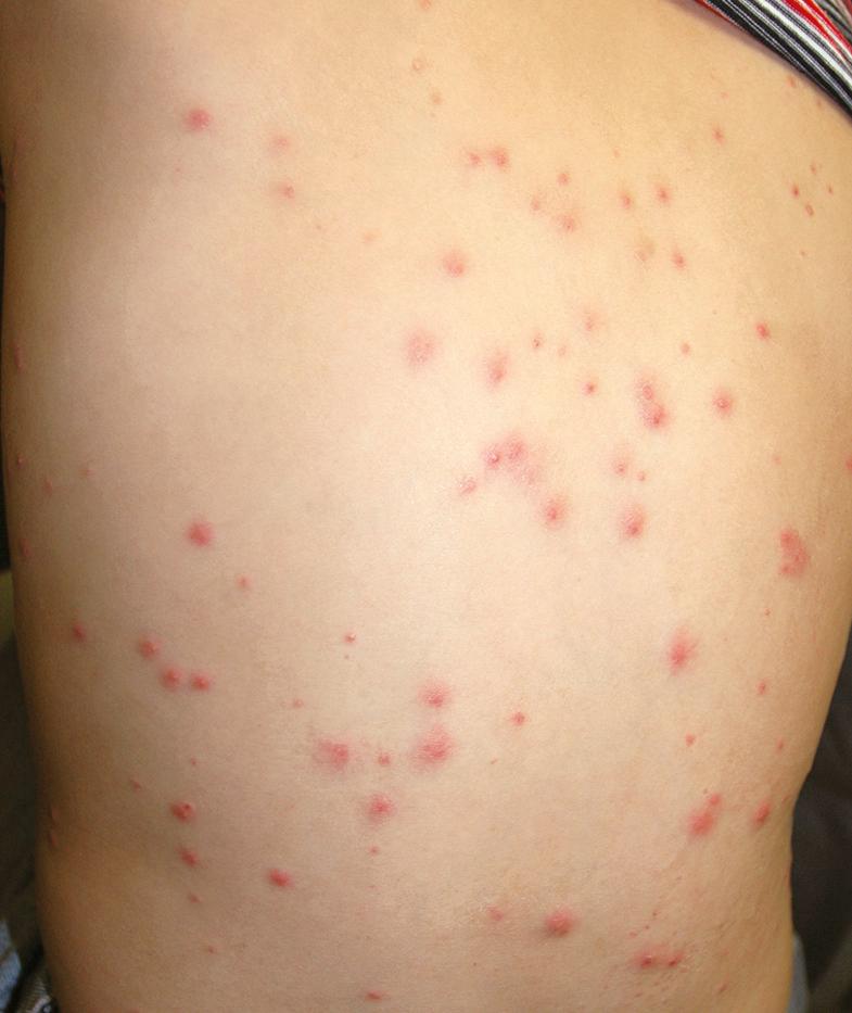 Fig. 38.2, Folliculitis (culture-negative).