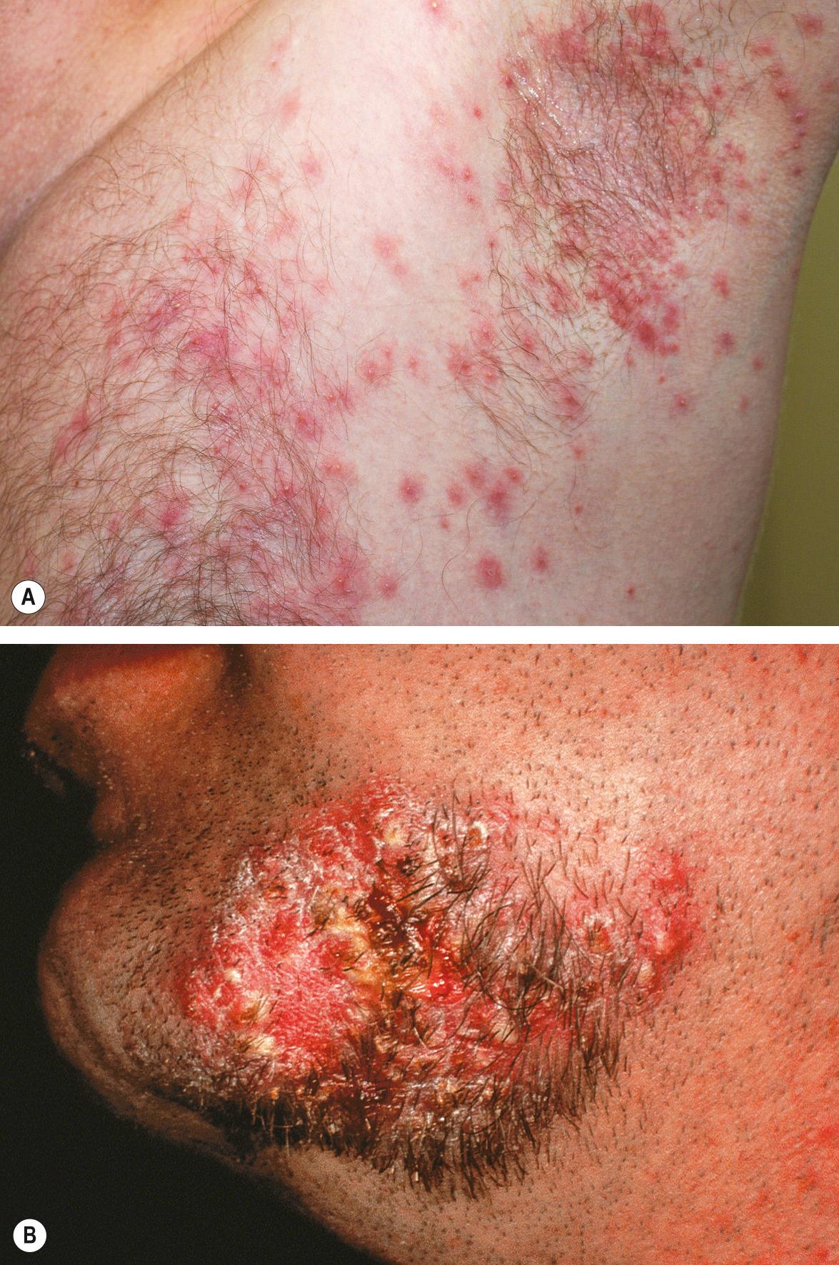 Fig. 38.3, Folliculitis of the axilla and beard area due to Staphylococcus aureus .