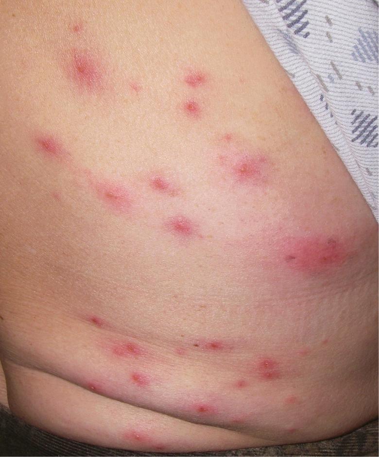 Fig. 38.4, Pseudomonas “hot tub” folliculitis.