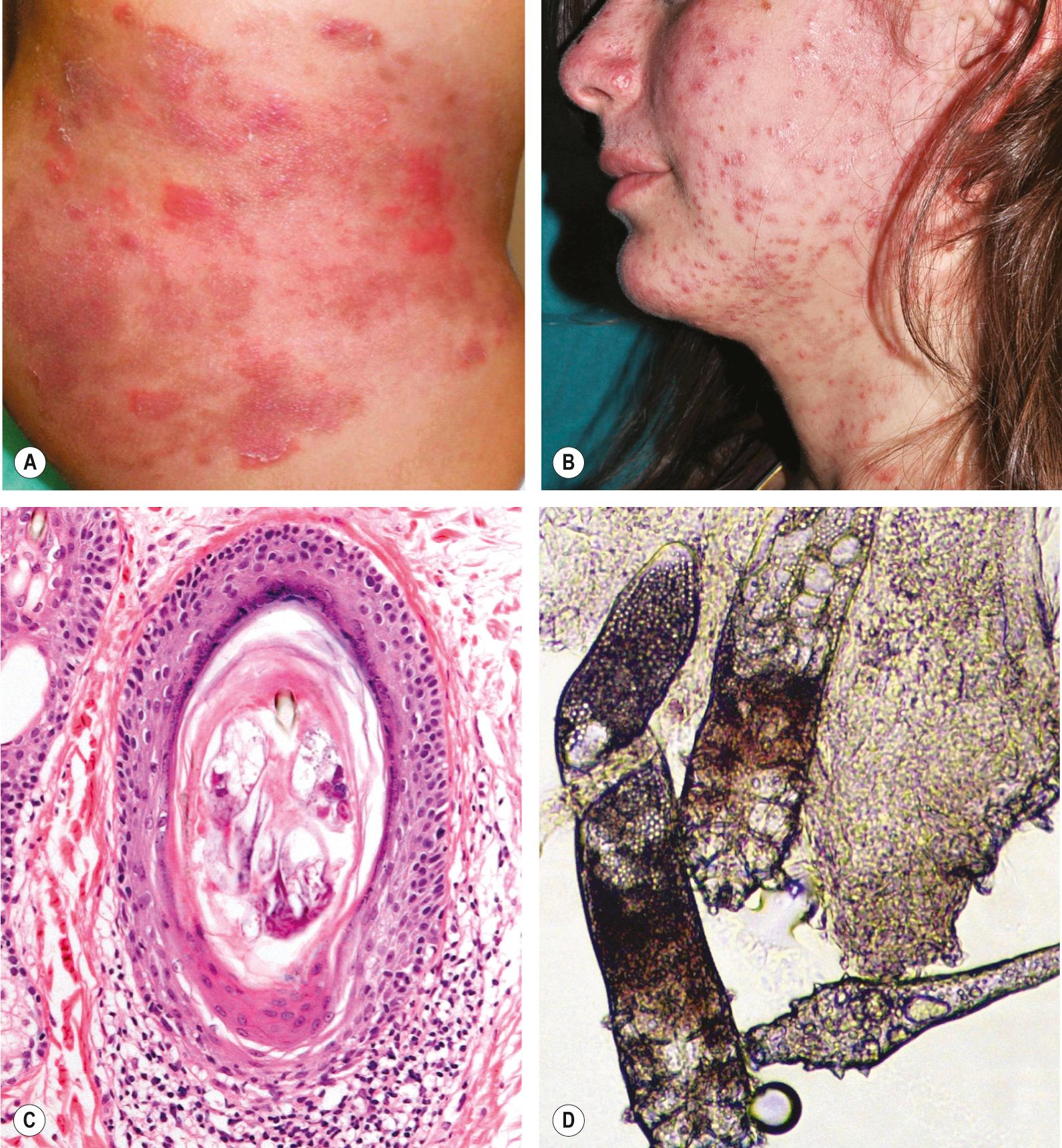 Fig. 38.5, Folliculitis – fungal and ectoparasitic.