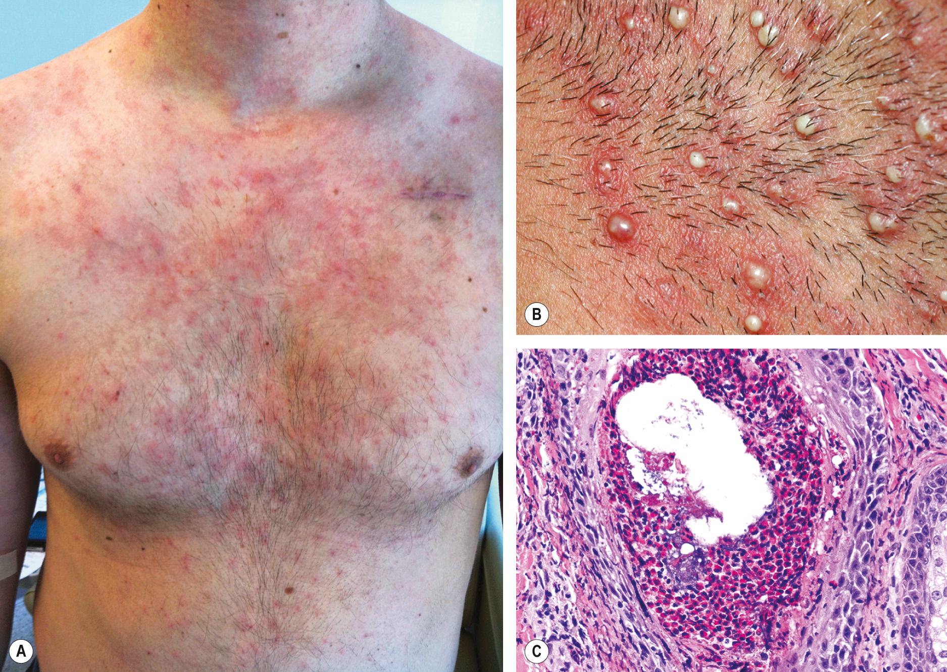 Fig. 38.6, Immunosuppression-associated eosinophilic folliculitis.