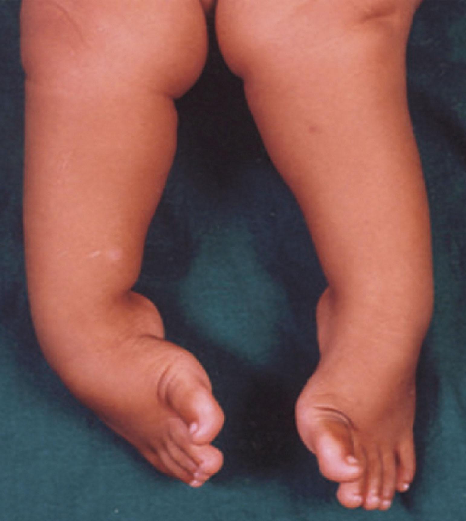 Figure 201.1, Clinical picture demonstrating clubfoot deformity.