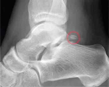 Foot Injuries - Clinical Tree