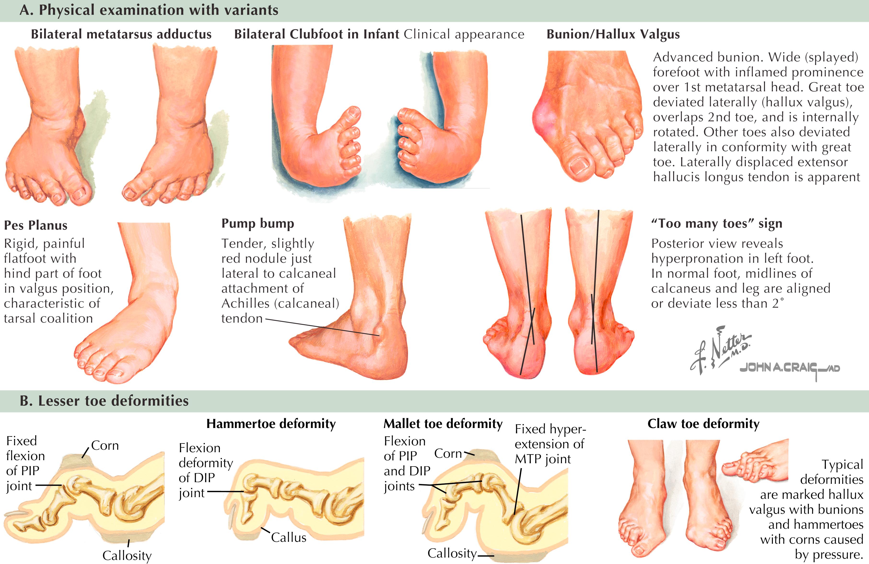 Figure 60.2, Physical examination of the toe and deformities.