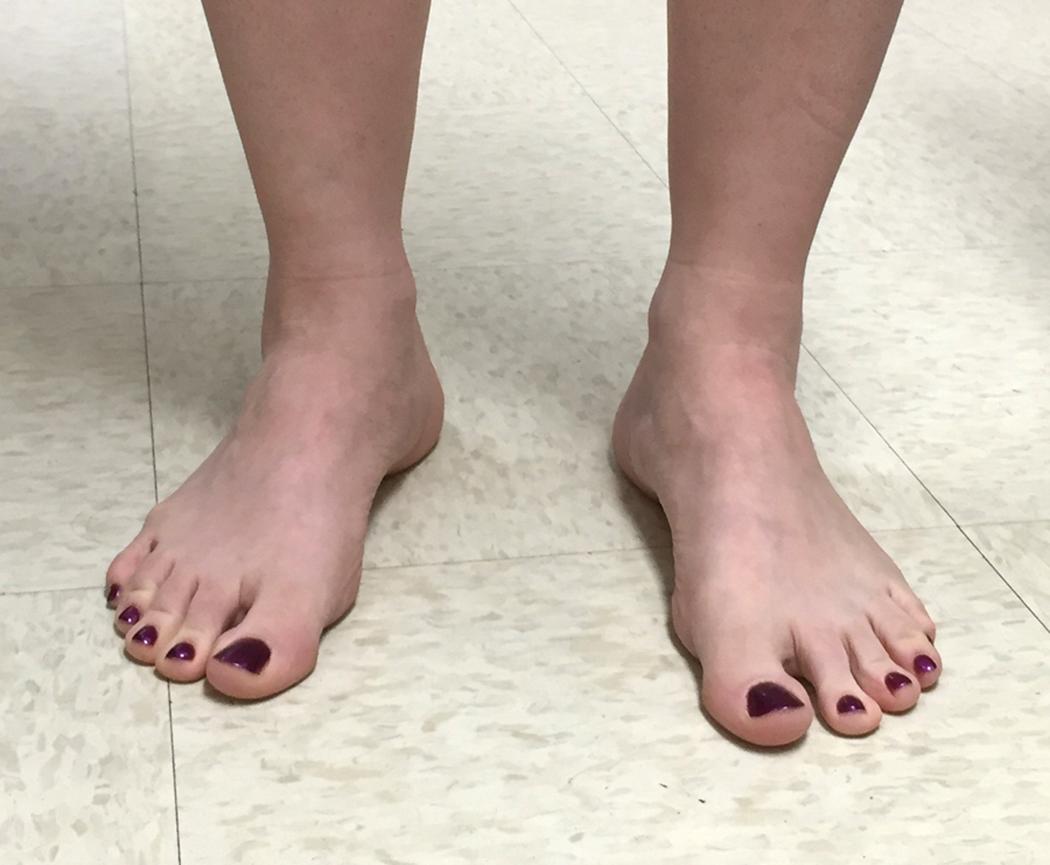 Figure 60.3, Peek-a-boo heel sign in hindfoot varus.