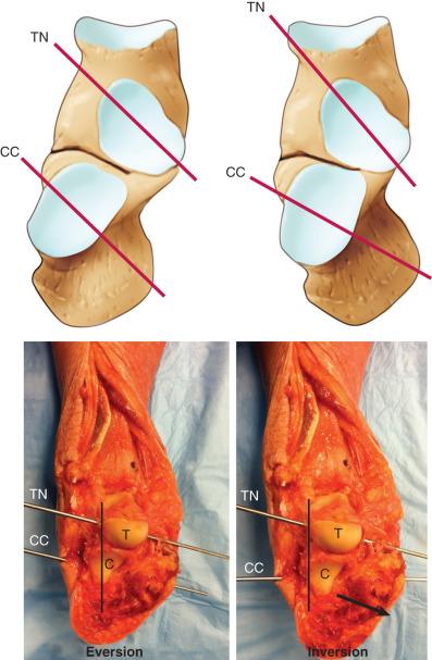 Fig. 110.11, The function of the transverse tarsal joint as described by Elftman. When the calcaneus is in eversion, the resultant axes of the talonavicular (TN) and calcaneocuboid (CC) joints are parallel or congruent. When the subtalar joint is in an inverted position, the axes are incongruent, giving increased stability to the midfoot. C, Calcaneal articular surface of the CC joint; T, talar articular surface of the TN joint.