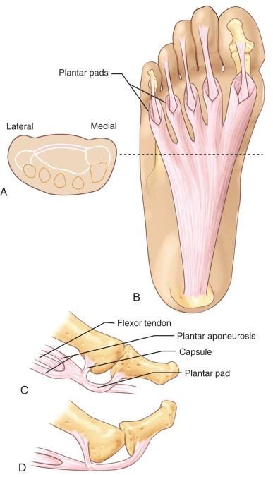 Fig. 110.12, Plantar aponeurosis. (A) Cross-section. (B) The plantar aponeurosis originates from the tubercle of the calcaneus and passes forward to insert into the base of the proximal phalanges. The aponeurosis divides, permitting the long flexor tendon to pass distally. (C) Components of the plantar pad and its insertion into the base of the proximal phalanx. (D) Extension of the toes draws the plantar pad over the metatarsal head, moving it into plantar flexion.