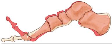 Fig. 110.13, The function of the plantar aponeurosis. The black outline shows the medial column with the foot at rest. The red figure shows the medial column with the first ray dorsiflexed. Note that dorsiflexion of the metatarsophalangeal joints tightens the plantar aponeurosis, which results in depression of the metatarsal heads, elevation and shortening of the longitudinal arch, inversion of the calcaneus, and elevation of the calcaneal pitch.