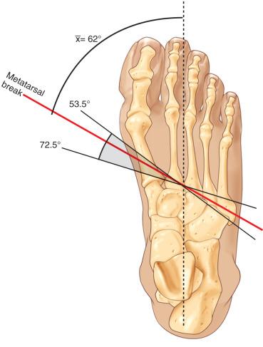 Fig. 110.14, The metatarsal break passes obliquely at an angle of approximately 62 degrees to the long axis of the foot.