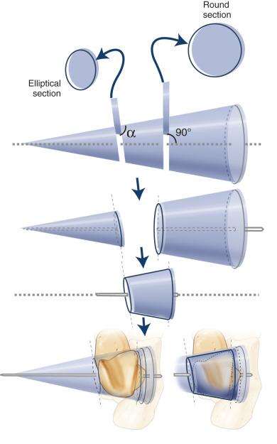 Fig. 110.4, The trochlear surface of the talus is a section from a cone. The apex of the cone is directed medially, and the open end is directed laterally.