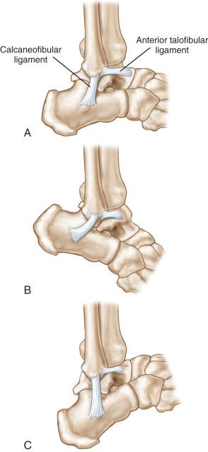 Fig. 110.6, Calcaneofibular (A) and anterior talofibular (B) ligaments. (A) In plantar flexion, the anterior talofibular ligament is in line with the fibula, thereby providing most of the support to the lateral aspect of the ankle joint. (B) When the ankle is in neutral position, both the anterior talofibular and the calcaneofibular ligaments support the joint. The obliquely placed structure depicts the axis of the subtalar joint. It should be noted that the calcaneofibular ligament parallels the axis. (C) When the ankle joint is in dorsiflexion, the calcaneofibular ligament is in line with the fibula and supports the lateral aspect of the joint.