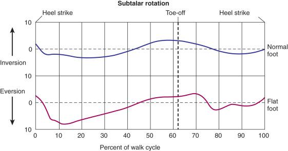 Fig. 110.10, Subtalar joint motion in a person with a normal foot and in a flat-footed person.