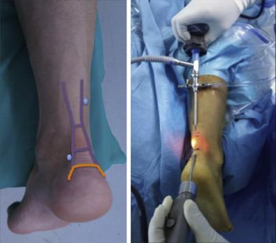 Fig. 19.1, Endoscopic achilles tendon portals for non-insertional Achilles disease.