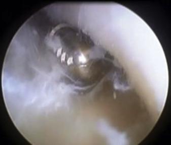 Fig. 19.2, Debridment of Kager’s fat pad and retrocalcaneal bursa adhesions on the deep tendon surface.