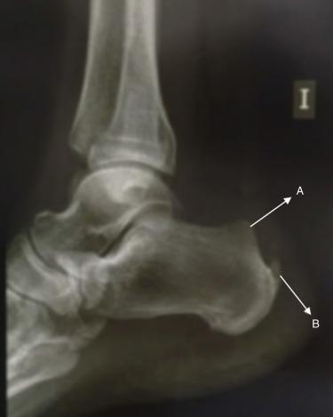 Fig. 19.3, Lateral x-ray view of the hindfoot. Enlarged posterosuperior aspect of the os calcis (A); calcaneal spurring at the insertion of the Achilles tendon (B).