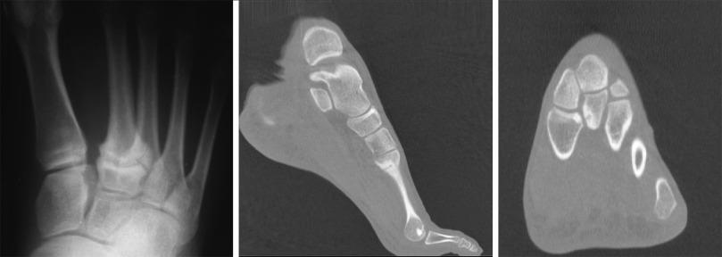 Fig. 24.11, Stress Fracture of the Base of the Second Metatarsal in Dancers.
