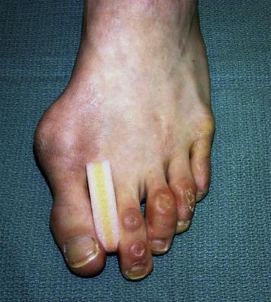 Fig. 24.3, Clinical picture of a ballet dancer treating hallux valgus deformity conservatively using a toe spacer in between first and second toes.