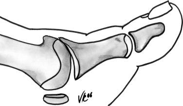 Fig. 24.4, Illustration of hallux rigidus.