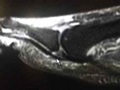 Fig. 24.9, Magnetic resonance image (sagittal plane) demonstrating injury of the plantar plate of the second metatarsophalangeal joint.