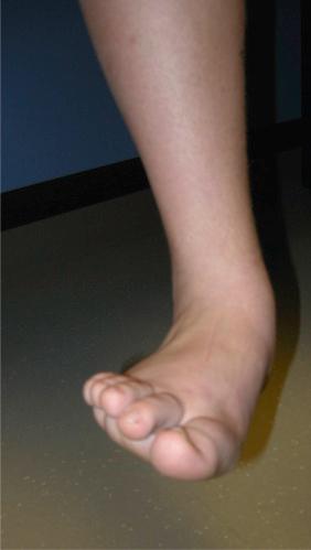 Fig. 138.1, This patient had a tarsal coalition in the right foot. Note that the foot is held in an everted position. Attempted inversion caused pain and resistance.