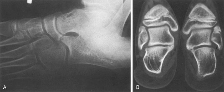 Fig. 138.2, Plain radiography (A) and a computed tomographic scan (B) showing calcaneonavicular and talocalcaneal coalitions, which occurred bilaterally in this patient. The patient presented with a painful, rigid foot and was having difficulty playing tennis.