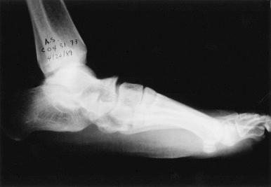 Fig. 138.3, A lateral radiograph of the foot. Note the beaking of the talus and the widening of the talonavicular joint. The subtalar joint is narrowed, and there is a C-sign. This is a dense line originating with the dome of the talus, continuing posteriorly, and ending with the sustentaculum talus.