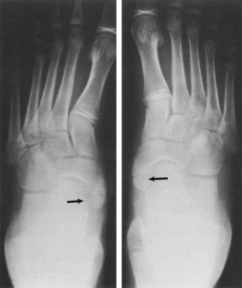 Fig. 138.4, Large bilateral cornuate prominent accessory naviculars (arrows) . They are joined by a synchondrosis to the navicular.