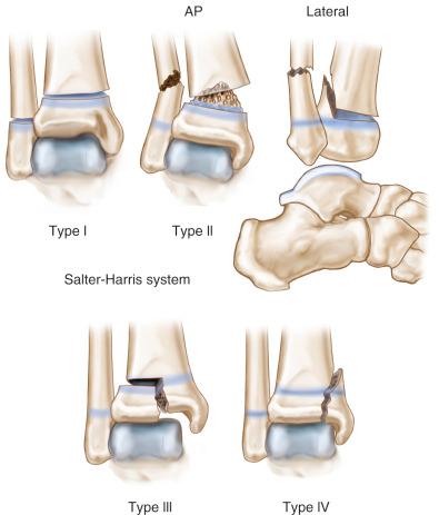 Fig. 138.6, Fracture patterns of the distal tibial and fibular physes classified by the Salter-Harris system. AP, Anteroposterior.