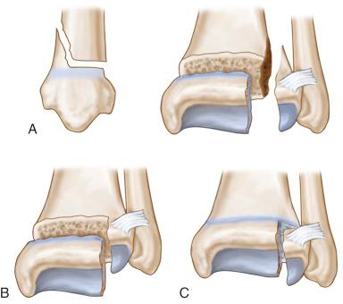 Fig. 138.7, (A) and (B) The triplane fracture can consist of two or more fragments. (C) The juvenile fracture of Tillaux.